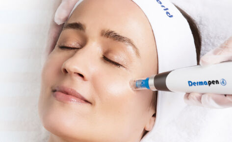 Microneedling